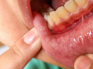 patologia bucal