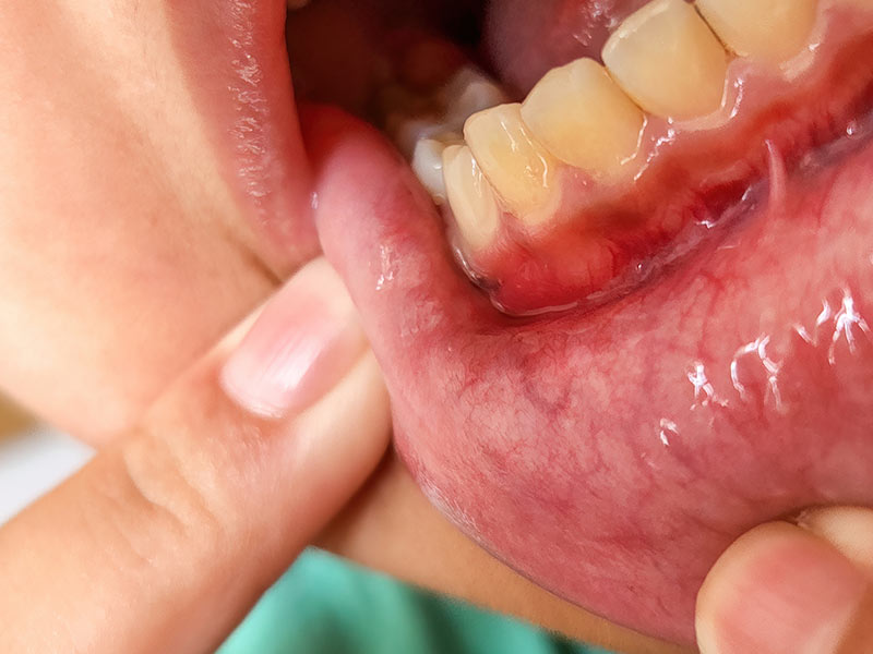 patologia bucal